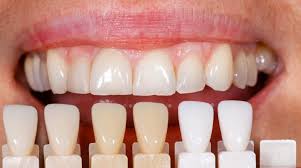 Can I Choose the Shade of My Veneers?